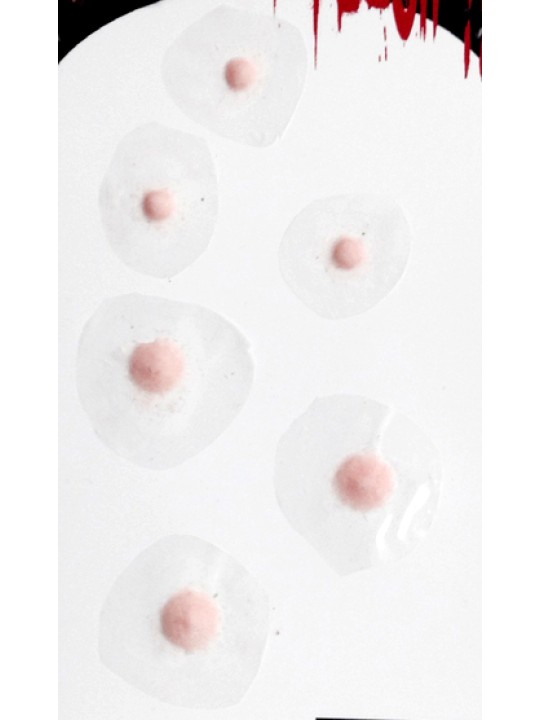 Cyst