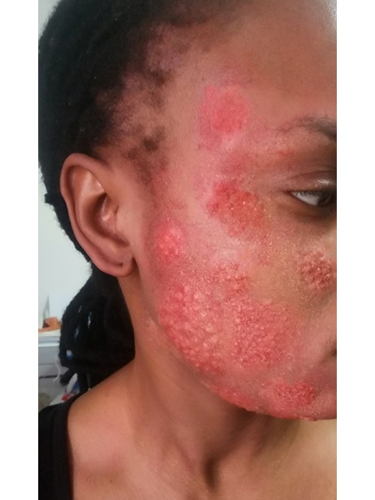 Inflammation